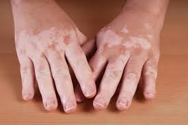 Microneedling with 5-fluorouracil an effective treatment option for vitiligo