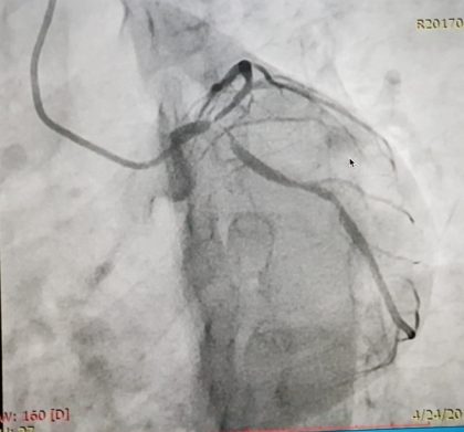 Distal Left Main Minicrush Bifurcation Stenting in MI in a young male: Case by Dr Gaurav Chaudhary