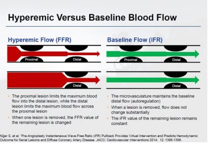 Diffuse disease, tandem lesions (FFR/iFR) -Dr Prashant Jagtap