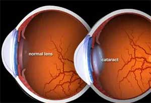 Diabetics twice more prone to develop cataract