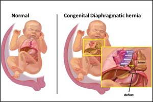 Revised CMAJ Guideline for Management of diaphragmatic hernia in children
