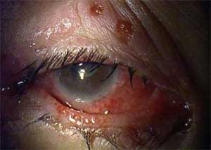 herpes simplex under eye