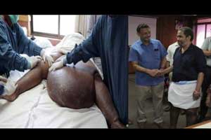 Doctors successfully remove a massive 14 kg mass from patient of lymphatic filariasis