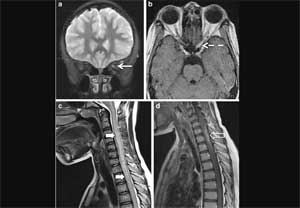 Cetrizine may help prevent relapse of neuromyelitis optica