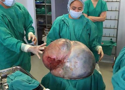 Ovarian tumour weighing more than 30 kg removed from woman