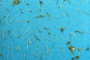 Unusual case : chinese doctor removes 100 fish bones from mans rectum