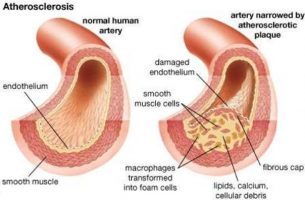 1 in 10 young patients with MI will have familial hypercholesterolemia: JACC Study