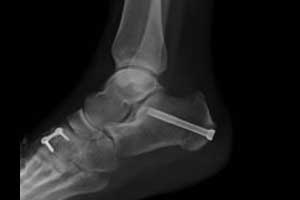 Surgical Management of Chronic Lateral Ankle Instability: Chinese Society of Sports Medicine Guidelines