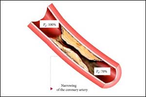 iFR safer & less expensive than FFR for patients needing PCI