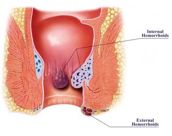 ASCRS Updated guidelines on Management of Hemorrhoids