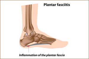 New Injection a hope for Recalcitrant Plantar Fasciitis Pain