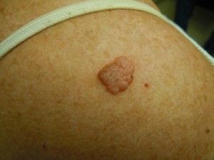 Topical hydrogen peroxide solution,a less toxic option for Seborrheic keratosis