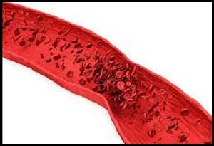 Arterial thrombosis in leg associated with increased risk of cancer