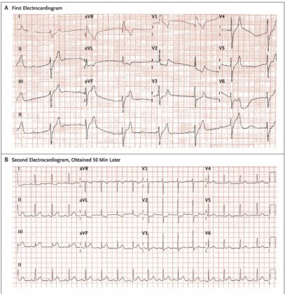 How a Nurse performs Self Thrombolysis in MI to save his life : NEJM case story