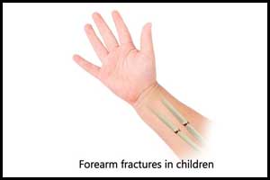 Vitamin D deficiency increases risk of severe forearm fractures in children