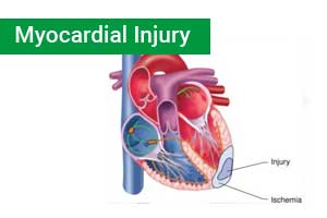 High sensitivity cardiac troponin may not rule out myocardial ischemia: Study