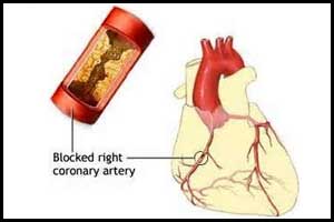 PCI  better than  medical therapy in stable Angina with coronary total occlusion