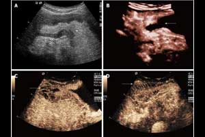 Contrast Ultrasound distinguishes gastric cancer from benign lesions