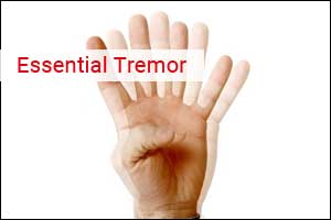 Wrist band to improve symptoms of Essential Tremor