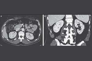 Lithium-Induced Nephropathy