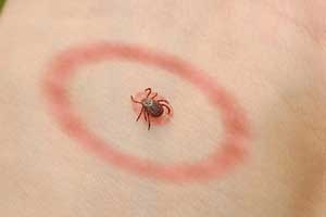 Researchers develop fast, inexpensive test for early diagnosis of  Lyme disease