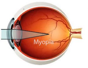 Retinal detachment increases with increasing degree of myopia, Study finds
