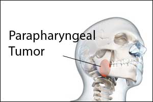 Doctors remove largest Parapharyngeal tumour Transorally