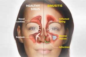 Study of Mucus to predict type of Sinusitis treatment for best outcomes