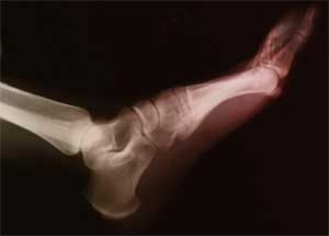 Casting & surgery equally effective in ankle fractures in Elderly