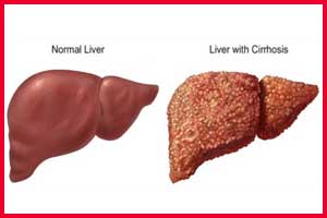 Diabetes patients at higher risk of liver cirrhosis and liver cancer
