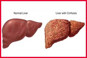 Albumin administration may prolong survival in cirrhosis