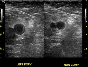 Ultrasound protocols for DVT: consensus recommendations