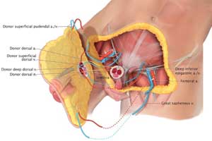 Worlds first: John Hopkins Doctors perform total penis and scrotum transplant