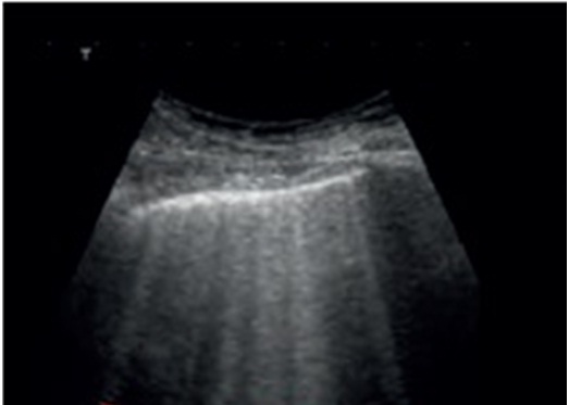 Can Lung ultrasound replace X-ray in mechanically ventilated patients ?