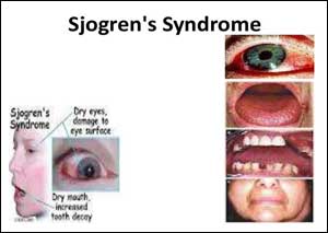 BSR Guideline for the Management of Primary Sjögrens Syndrome
