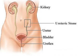 Do Alpha-blockers improve outcomes of patients of ureteral stones?