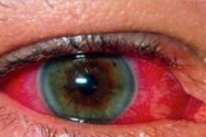 Increased Risk of Uveitis Associated With Hypovitaminosis D