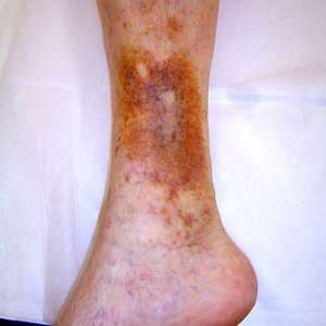 Silver dressings better than others in Venous Leg Ulcer Treatment