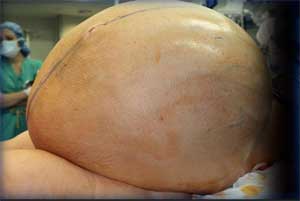 132-pound tumor removed from woman’s abdomen in Connecticut