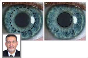 Understanding Artificial Cornea Or Keratoprosthesis- Dr QB Maskati