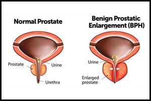 Aquablation better than TURP when treating large prostates