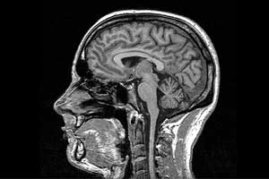 MRI of Idiopathic Intracranial hypertension: Before and after treatment