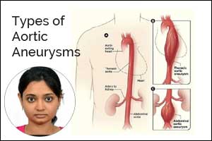 Imaging of acute traumatic aortic injury