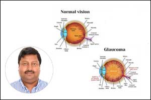 LVPEI doctors discover New Genes that result in childhood glaucoma