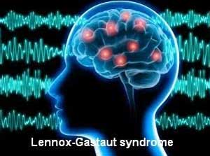 Cannabidiol to reduce Drop Seizures in the Lennox–Gastaut Syndrome:Phase 3 Trial