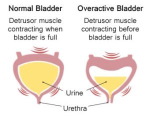 New treatment for Overactive Bladder Approved by FDA