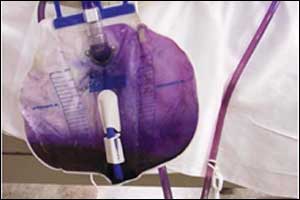 Purple urine in torsades de pointes: NEJM case report