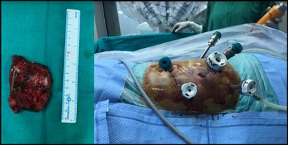 Indian doctors remove a large tumor through robotic surgery in a 14-year-old child