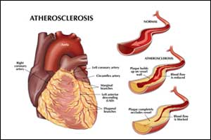 Genes to Medicine - An Injection to reverse atherosclerosis