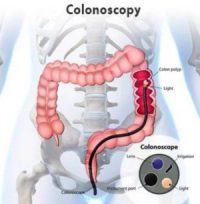 Blue dye tablet helps identify polyps during colonoscopy